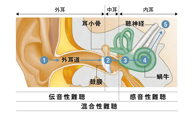 難聴について知る